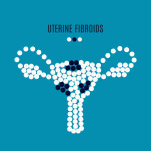 uterine fibroids